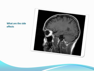 What are the side effects