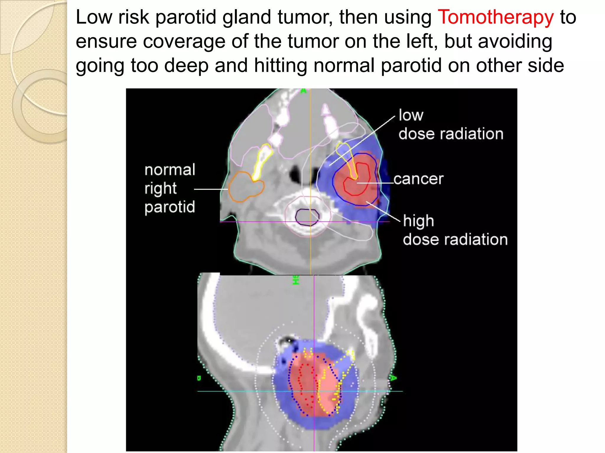 Radiation for head and neck cancer video | PPTX