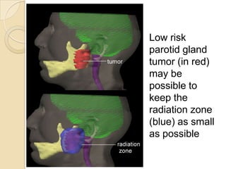 Radiation for head and neck cancer video | PPTX