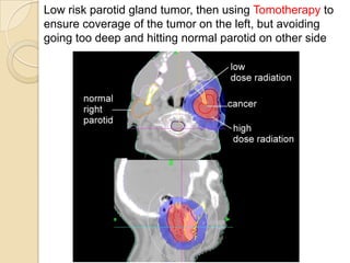 Radiation for head and neck cancer video | PPTX