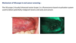 Velscope System radiation physics in Oral and Maxillofacial Radiology | PPTX