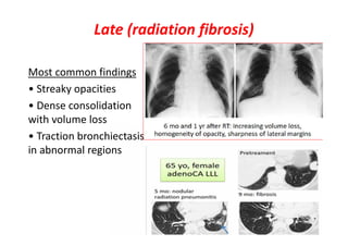 Late (radiation fibrosis)
common findingsMost
• Streaky opacities
• Dense consolidation
with volume loss
• Traction bronchiectasis
in abnormal regions
 