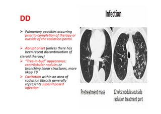 DD
 Pulmonary opacities occurring
prior to completion of therapy or
outside of the radiation portal.
 Abrupt onset (unless there has
been recent discontinuation of
steroid therapy)
 “Tree-in-bud” appearance:
centrilobular nodules or
branching linear structures, more
likely TB
 Cavitation within an area of
radiation fibrosis generally
represents superimposed
infection
 