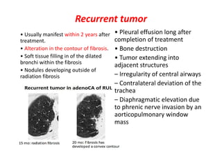 Recurrent tumor
• Usually manifest within 2 years after
treatment.
• Alteration in the contour of fibrosis.
• Soft tissue filling in of the dilated
bronchi within the fibrosis
• Nodules developing outside of
radiation fibrosis
• Pleural effusion long after
completion of treatment
• Bone destruction
• Tumor extending into
adjacent structures
– Irregularity of central airways
– Contralateral deviation of the
trachea
– Diaphragmatic elevation due
to phrenic nerve invasion by an
aorticopulmonary window
mass
 