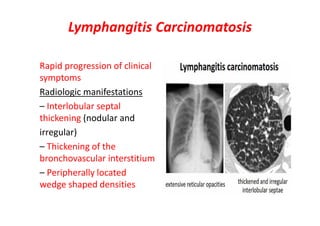 Lymphangitis Carcinomatosis
Rapid progression of clinical
symptoms
Radiologic manifestations
– Interlobular septal
thickening (nodular and
irregular)
– Thickening of the
bronchovascular interstitium
– Peripherally located
wedge shaped densities
 