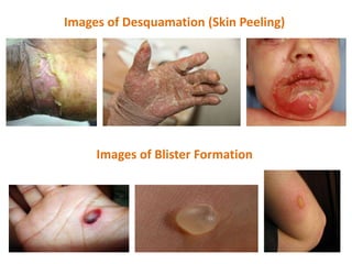 Images of Desquamation (Skin Peeling)
Images of Blister Formation
 