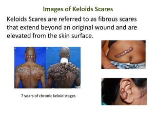 Images of Keloids Scares
Keloids Scares are referred to as fibrous scares
that extend beyond an original wound and are
elevated from the skin surface.
7 years of chronic keloid stages
 