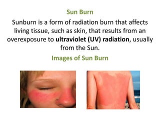 Sun Burn
Sunburn is a form of radiation burn that affects
living tissue, such as skin, that results from an
overexposure to ultraviolet (UV) radiation, usually
from the Sun.
Images of Sun Burn
 