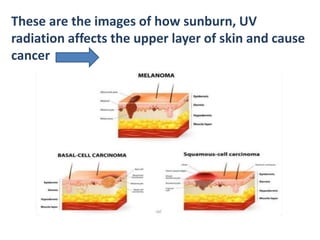 These are the images of how sunburn, UV
radiation affects the upper layer of skin and cause
cancer
 