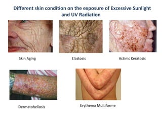 Different skin condition on the exposure of Excessive Sunlight
and UV Radiation
Skin Aging Elastosis
Dermatoheliosis Erythema Multiforme
Actinic Keratosis
 