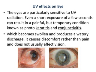 UV effects on Eye
• The eyes are particularly sensitive to UV
radiation. Even a short exposure of a few seconds
can result in a painful, but temporary condition
known as photo keratitis and conjunctivitis.
• which becomes swollen and produces a watery
discharge. It causes discomfort rather than pain
and does not usually affect vision.
 