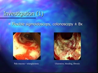 Investigation (1) Flexible sigmoidoscopy, colonoscopy  ± Bx  Pale mucosa + telangiectasia Ulceration, bleeding, fibrosis 