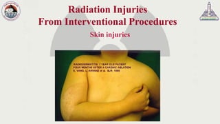 Radiation Injries Radiation Protection Course For Orthopedic Specialists Lecture 2 of 4 ...