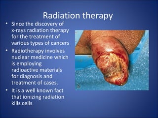 Radiation therapy
• Since the discovery of
  x-rays radiation therapy
  for the treatment of
  various types of cancers
• Radiotherapy involves
  nuclear medicine which
  is employing
  radioactive materials
  for diagnosis and
  treatment of cases.
• It is a well known fact
  that ionizing radiation
  kills cells
 