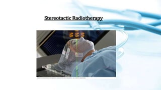Stereotactic Radiotherapy
 