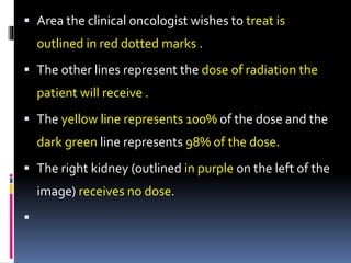  Area the clinical oncologist wishes to treat is
outlined in red dotted marks .
 The other lines represent the dose of radiation the
patient will receive .
 The yellow line represents 100% of the dose and the
dark green line represents 98% of the dose.
 The right kidney (outlined in purple on the left of the
image) receives no dose.

 