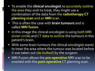  To enable the clinical oncologist to accurately outline
the area they wish to treat, they might use a
combination of the data from the radiotherapy CT
planning scan and an MRI scan.
 This is often the case with brain tumours and is
called MRI fusion.
 In this image the clinical oncologist is using both MRI
(inner circle) and CT data to outline the tumours in this
patient's brain.
 With some brain tumours the clinical oncologist wants
to treat the area where the tumour was located before
it was taken out (de-bulked) by the surgeon.
 MRI Fusion allows the pre-operative MRI scan to be
overlaid with the post-operative CT planning scan.
 