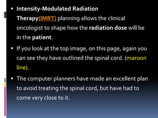  Intensity-Modulated Radiation
Therapy(IMRT) planning allows the clinical
oncologist to shape how the radiation dose will be
in the patient.
 If you look at the top image, on this page, again you
can see they have outlined the spinal cord. (maroon
line).
 The computer planners have made an excellent plan
to avoid treating the spinal cord, but have had to
come very close to it.
 