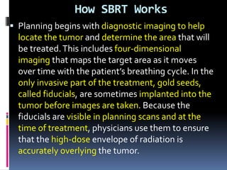 How SBRT Works
 Planning begins with diagnostic imaging to help
locate the tumor and determine the area that will
be treated.This includes four-dimensional
imaging that maps the target area as it moves
over time with the patient’s breathing cycle. In the
only invasive part of the treatment, gold seeds,
called fiducials, are sometimes implanted into the
tumor before images are taken. Because the
fiducials are visible in planning scans and at the
time of treatment, physicians use them to ensure
that the high-dose envelope of radiation is
accurately overlying the tumor.
 