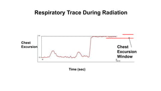 Radiation Therapy for Inflammatory Breast Cancer | PPTX