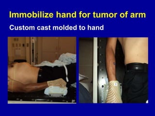 Immobilize hand for tumor of arm
Custom cast molded to hand
•
 