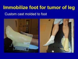 Immobilize foot for tumor of leg
Custom cast molded to foot
 