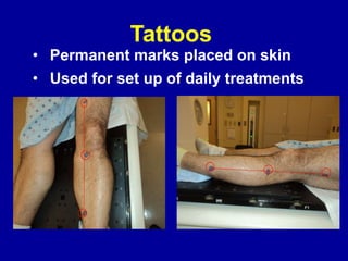 Tattoos
• Permanent marks placed on skin
• Used for set up of daily treatments
 