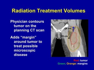 Radiation Treatment Volumes
Physician contours
tumor on the
planning CT scan
Adds “margin”
around tumor to
treat possible
microscopic
disease
4 cm
1.5 cm
Red: tumor
Green, Orange: margins
 