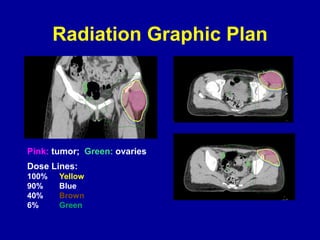Radiation Graphic Plan
Pink: tumor; Green: ovaries
Dose Lines:
100% Yellow
90% Blue
40% Brown
6% Green
 