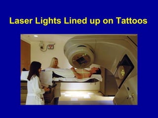 Laser Lights Lined up on Tattoos
 