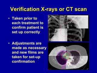 Verification X-rays or CT scan
• Taken prior to
each treatment to
confirm patient is
set up correctly
• Adjustments are
made as necessary
and new films are
taken for set-up
confirmation
 