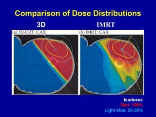 Comparison of Dose Distributions
Isodoses
Red: 100%
Light blue: 20-30%
3D IMRT
 