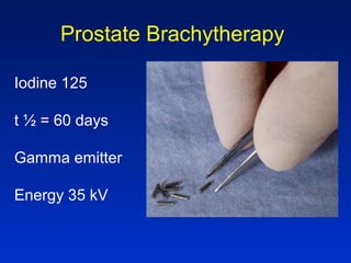 Prostate Brachytherapy
Iodine 125
t ½ = 60 days
Gamma emitter
Energy 35 kV
 