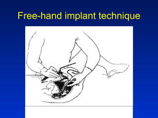 Free-hand implant technique
 