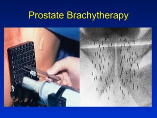 Prostate Brachytherapy
 