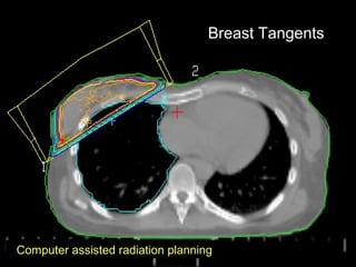 Breast Tangents
Computer assisted radiation planning
 