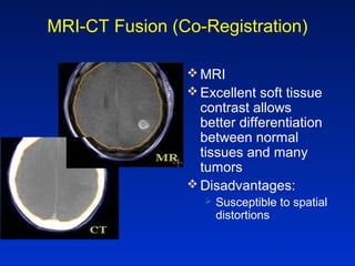 MRI-CT Fusion (Co-Registration)
 MRI
 Excellent soft tissue
contrast allows
better differentiation
between normal
tissues and many
tumors
 Disadvantages:
 Susceptible to spatial
distortions
 