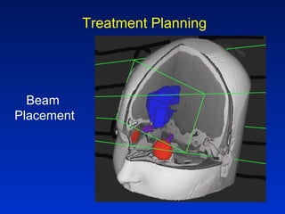 Treatment Planning
Beam
Placement
 
