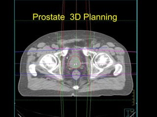 Prostate 3D Planning
 