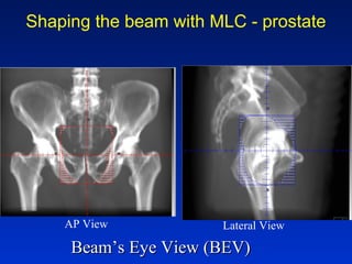 Shaping the beam with MLC - prostate
Beam’s Eye View (BEV)Beam’s Eye View (BEV)
AP View Lateral View
 