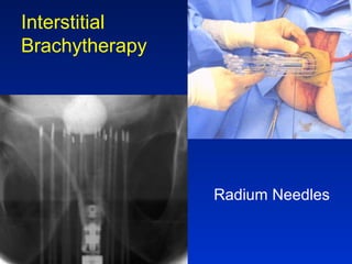 Interstitial
Brachytherapy
Radium Needles
 