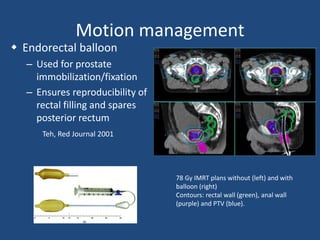 Motion management 
 Endorectal balloon 
– Used for prostate 
immobilization/fixation 
– Ensures reproducibility of 
rectal filling and spares 
posterior rectum 
Teh, Red Journal 2001 
78 Gy IMRT plans without (left) and with 
balloon (right) 
Contours: rectal wall (green), anal wall 
(purple) and PTV (blue). 
 