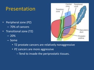 Presentation 
• Peripheral zone (PZ) 
– 70% of cancers 
• Transitional zone (TZ) 
– 20% 
– Some 
• TZ prostate cancers are relatively nonaggressive 
• PZ cancers are more aggressive 
– Tend to invade the periprostatic tissues. 
 