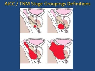AJCC / TNM Stage Groupings Definitions 
 