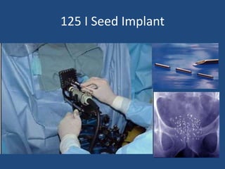 125 I Seed Implant 
 