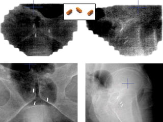 Fidutial Placement 
• TRUS Guided 
• 1 week prior to simulation 
 