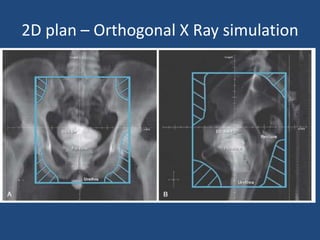 2D plan – Orthogonal X Ray simulation 
 