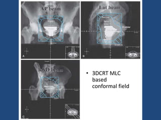 • 3DCRT MLC 
based 
conformal field 
 