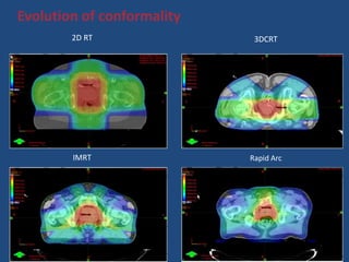 Evolution of conformality 
2D RT 3DCRT 
IMRT Rapid Arc 
 