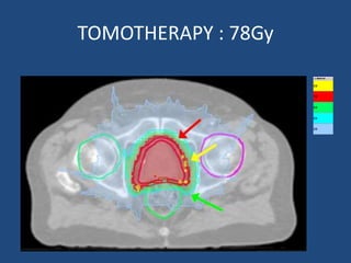 TOMOTHERAPY : 78Gy 
 